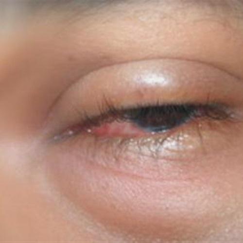 3 أسباب تؤدي إلى إصابة العيون بالانتفاخ
