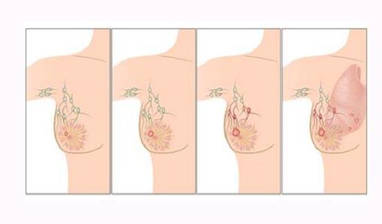 الأسباب الرئيسية لسرطان الثدي التي يجب معرفتها