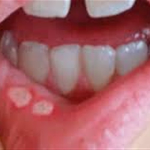 7 نصائح تحمي من جفاف والتهابات الفم