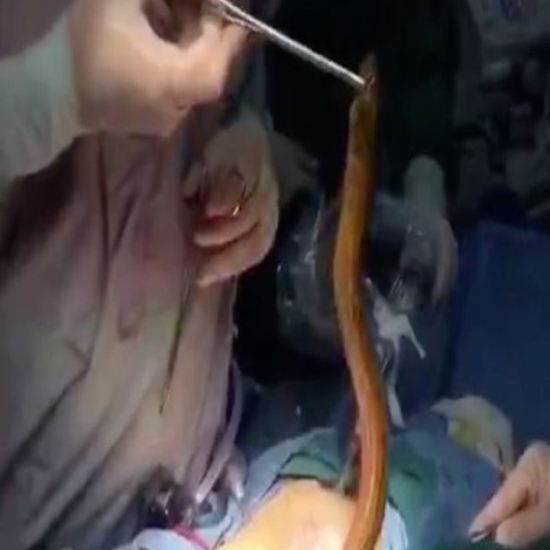 استخراج ثعبان من جسم مريض في الصين كيف دخل فيديو
