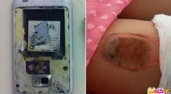 بالصور احتراق فتاة نتيجة انفجار هاتفها المحمول في جيبها