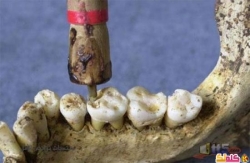 لعلاج الأسنان في الماضي