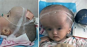 طفلة صينية تصبح أول شخص في العالم بجمجمة اصطناعية