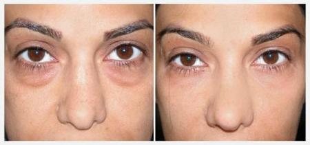 العلاجات الفورية للتخلص من انتفاخ العينين طبيعياً