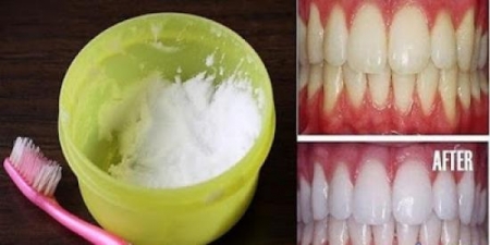 شاهد أسنان بيضاء في 3 دقائق وصفة مذهلة ! طريقة مجربة و فعالة 100 