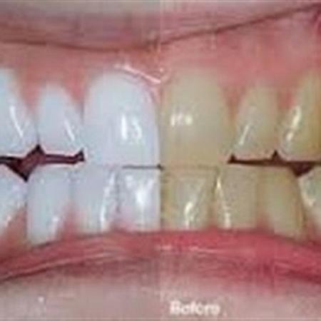 بالفيديو وصفة سحرية تمنحك أسنانا بيضاء كالثلج