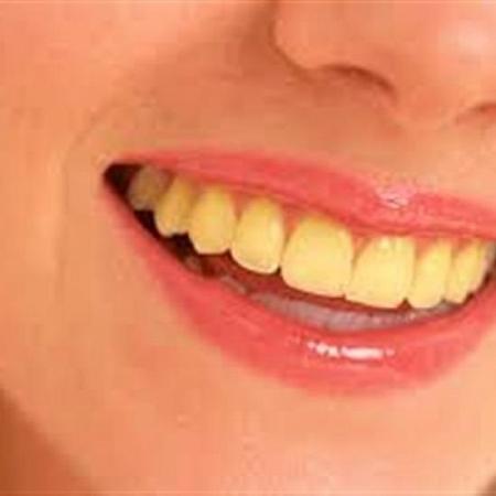 5 وصفات مذهلة لتبييض الأسنان وعلاج نزيف اللثة