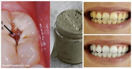 عالجوا تسوس الأسنان ومشاكل اللثة وبيضّوا أسنانكم بهذا المعجون المنزلي الطبيعي 