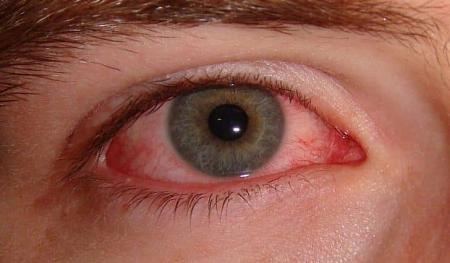 طريقة سهلة للتخلص من التهاب العين