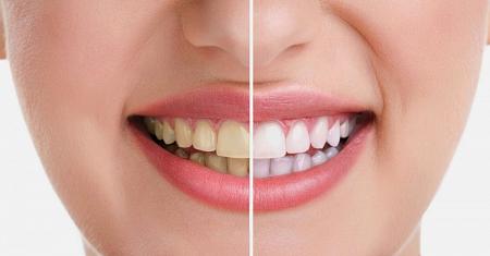 تبييض الاسنان بشكل سليم اتبع تلك النصائح لابتسامة رائعة