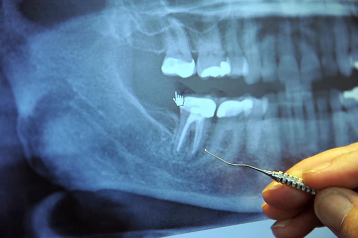 97 بالمئة من مرضى السرطان في مرحلته النهائية سبق وقاموا بهذه العملية عند طبيب الأسنان!