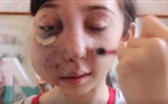 بالفيديو والصور.. فتاة مشوهة الوجه تتحول لنجمة يوتيوب بنصائح المكياج