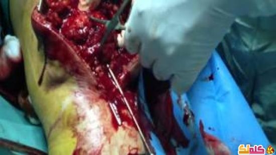 عملية جراحية لمصاب في الركبة