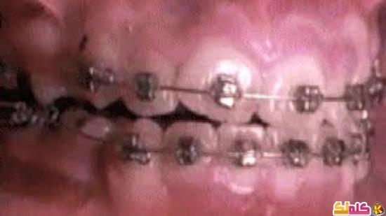 كيف تعمل دعامات الأسنان