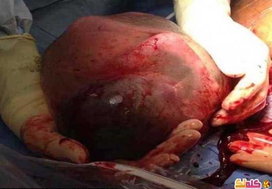 معجزة طبية ولادة طفل داخل الكيس الأمينوسى