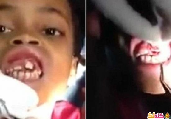 طبيب أسنان يعثر عن 15 دودة داخل فم طفلة برازيلية
