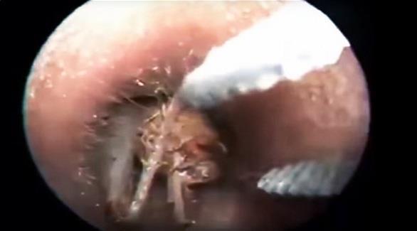 بالفيديو لحظة إخراج حشرة ضخمة من أذن رجل