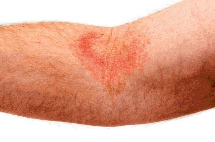 ما هي حساسية الجلد التأتبي 