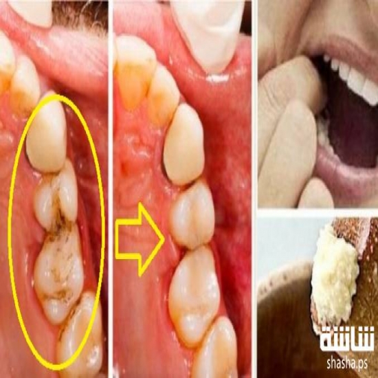 تخلص من ألم الأسنان المزمن بطرق طبيعية و سهلة 