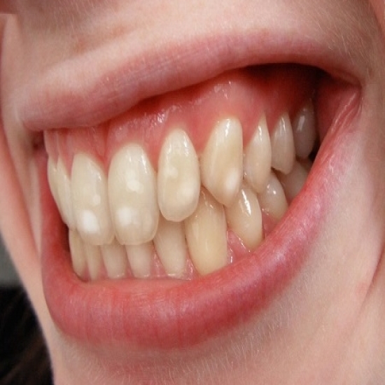 مما تظهر البقع البيضاء المزعجة على الأسنان 