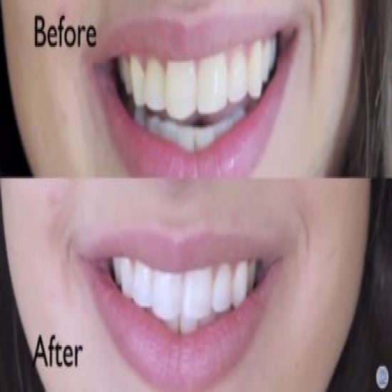 وصفة طبيعية للتخلص من إصفرر الأسنان بالليمون جربوها