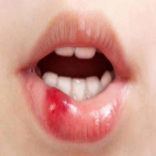 هذه العوارض البسيطة التي قد تؤدي الى سرطان الفم 
