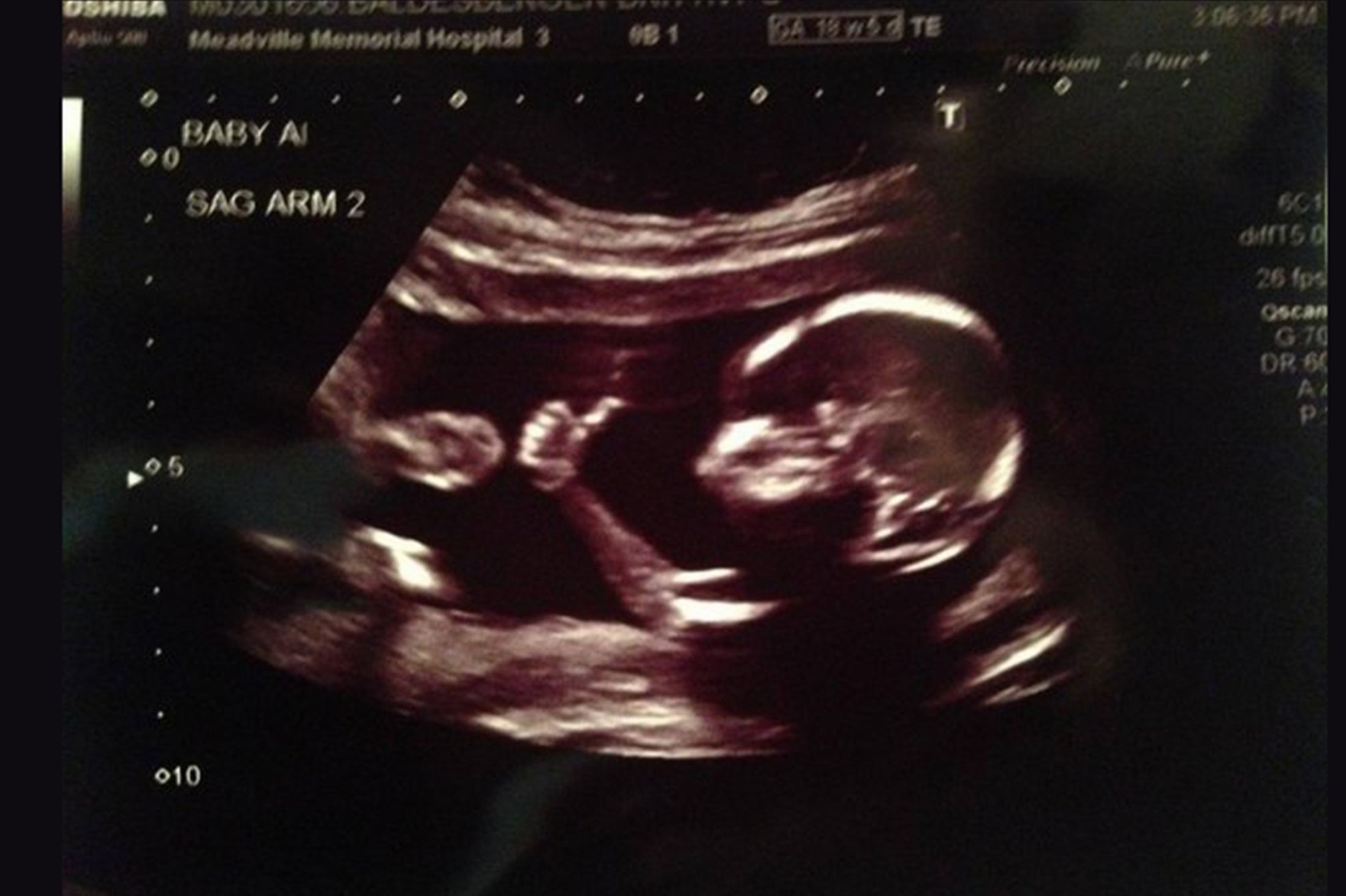 Baby-gives-thumbs-up-on-ultrasound