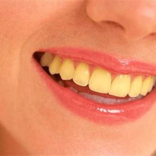 5 أدوية تتسبب في اصفرار الأسنان اكتشفيها
