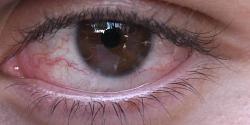 كمادات البابونج غير مناسبة لعلاج احمرار العين