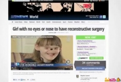 بالفيديو فتاة تعيش بدون أنف وعينين حيرت العالم ! 