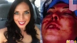 عارضة أزياء تحاكم شرطة المرور بعد أن قاموا ببطحها أرضاً متسببين بتحطيم وجهها