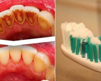 ازالة طبقة البلاك او الجير وتبييض الاسنان وقتل البكتيريا بخطوة واحده فقط