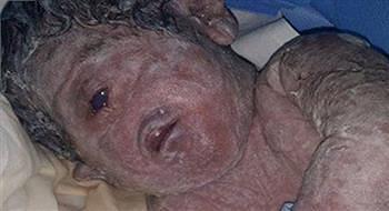 مصر ولادة طفل بدون أنف وبعين واحدة