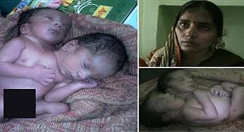 ولادة طفل برأسين في الهند والأب يعتقد أنه عقاب الآلهة