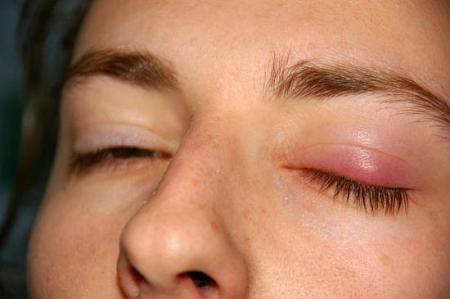 علاج خراج العين بوصفات منزلية سهله