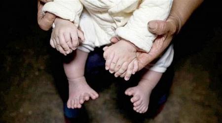 طفل صيني يولد بـ 31 اصبعاً في يديه وقدميه