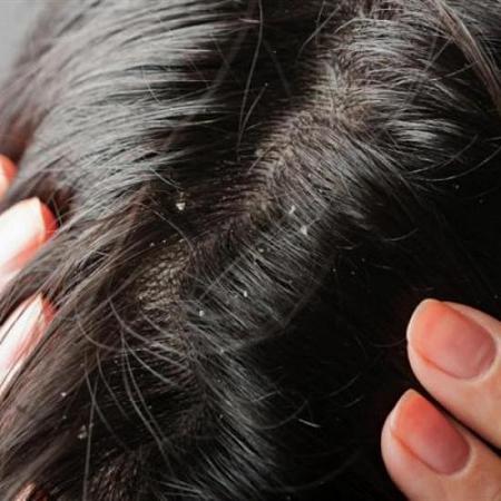 4 مواد طبيعية تخلصك من القشرة وتحافظ على صحة شعرك