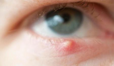 علاج خراج العين بطرق سهلة داخل المنزل