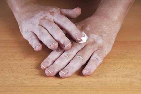 7 وصفات طبيعية فعالة لعلاج مرض البهاق vitiligo وإزالة البقع البيضاء من الجلد