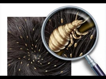 18 طريقة لعلاج حشرات الشعر والتخلص منها