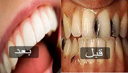 الطريقة الرائعة والبسيطة للتخلص من تسوس الاسنان والجير المتراكم عليها