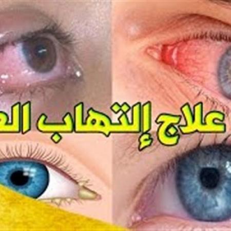 بالفيديو وصفة طبيعية تخلصك من التهابات واحمرار العين