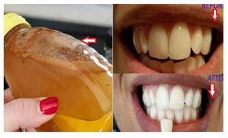 طريقة استخدام خل التفاح في تبييض و تنظيف الأسنان و ازالة البقع الصفراء