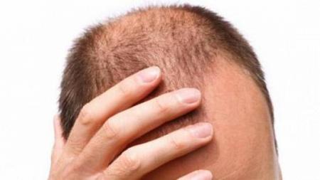ماذا يحدث للأصلع بعد زراعة الشعر؟