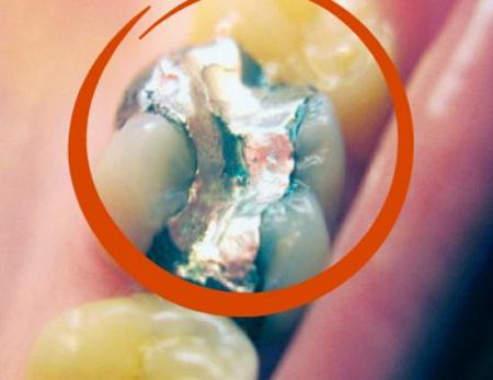 أكتشاف طبي خطير حشوة أسنان دائمة تمنع التسوس