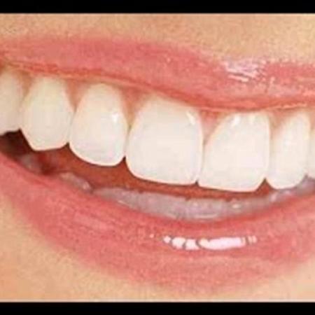 بالفيديو وصفة طبيعية للتخلص من جير الأسنان نهائيا