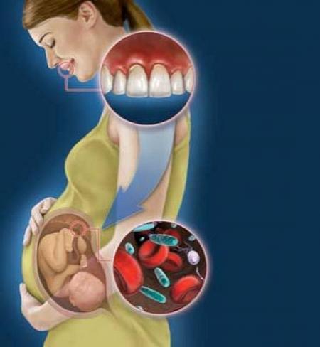 علاج مخاطر مشاكل الاسنان بالحمل