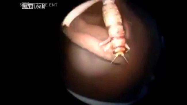 بالفيديو إزالة حشرة دخلت أذن امرأة وهي نائمة