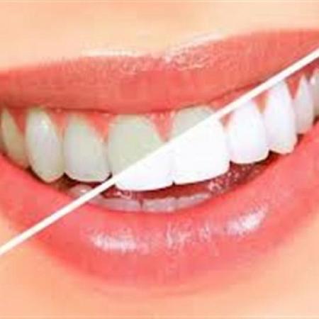 وصفة طبيعية لتبيض الأسنان في دقيقة واحدة
