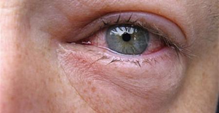 6 أعراض مرضية يسببها ارتفاع ضغط العين بعد الأربعين